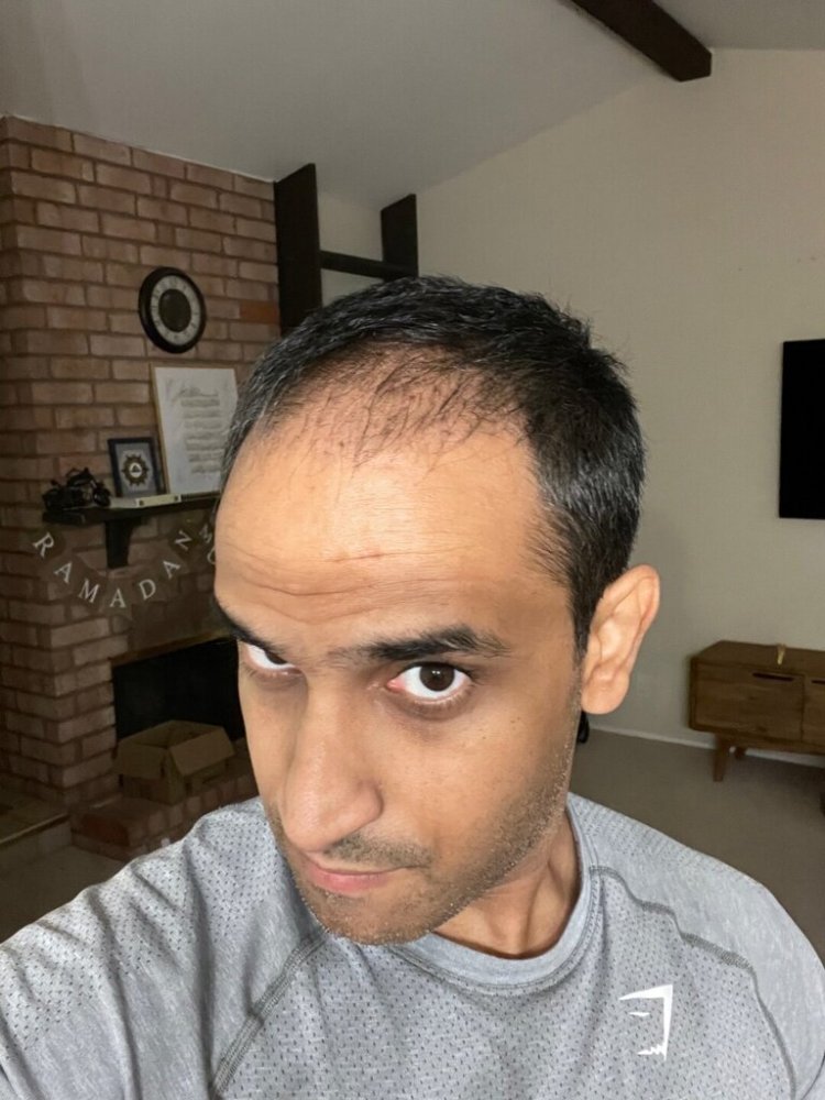 Dr. Ron Shapiro hair transplant2.jpeg