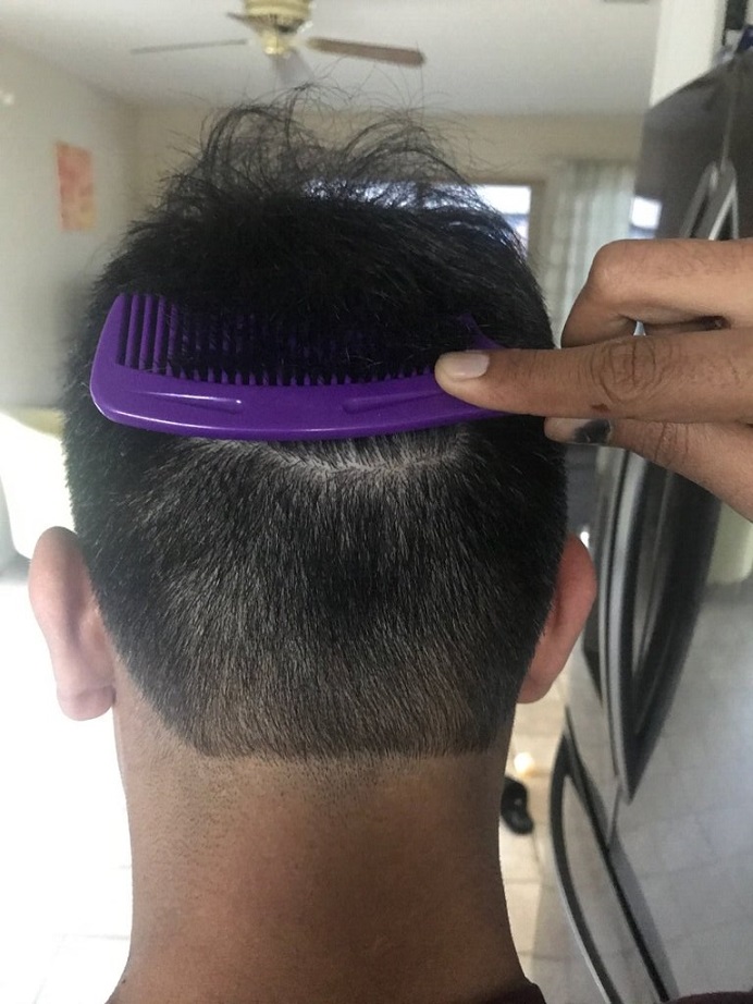 Dr. Ron Shapiro Hair Transplant3.jpeg