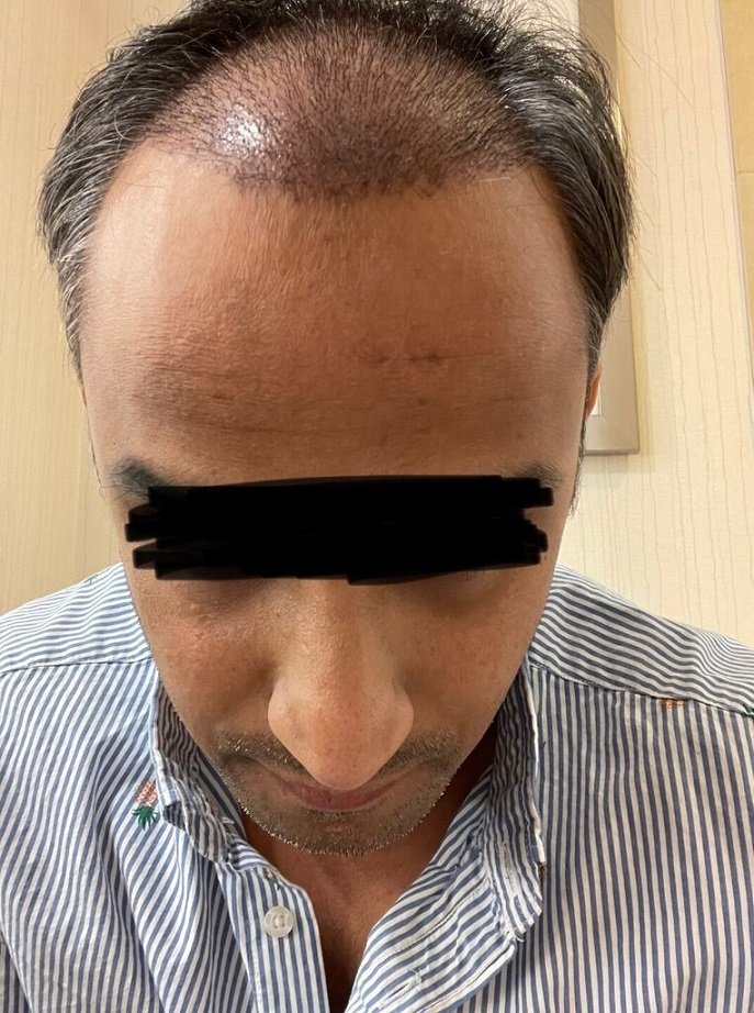 Dr. Ron Shapiro Hair Transplant4.jpeg
