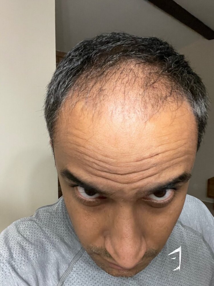 Dr. Ron Shapiro hair transplant4.jpeg
