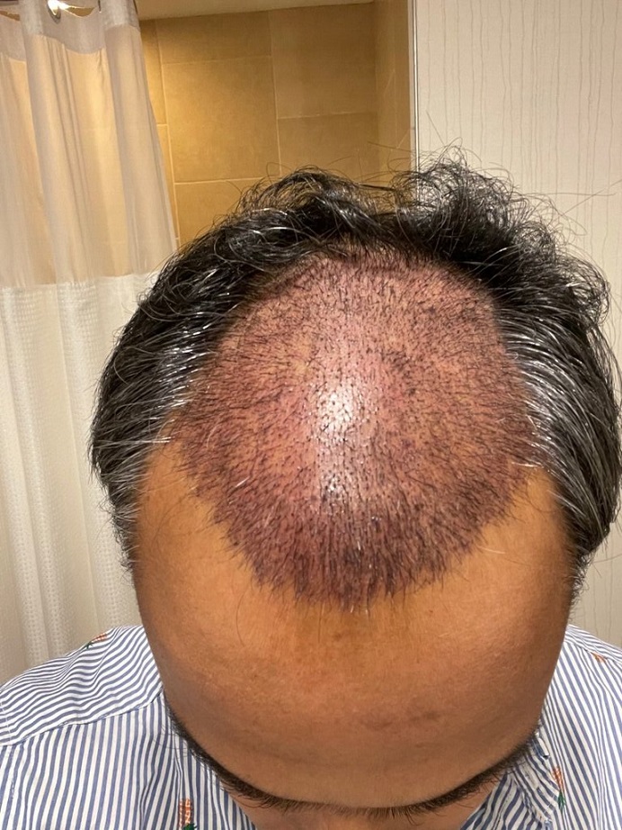 Dr. Ron Shapiro Hair Transplant5.jpeg