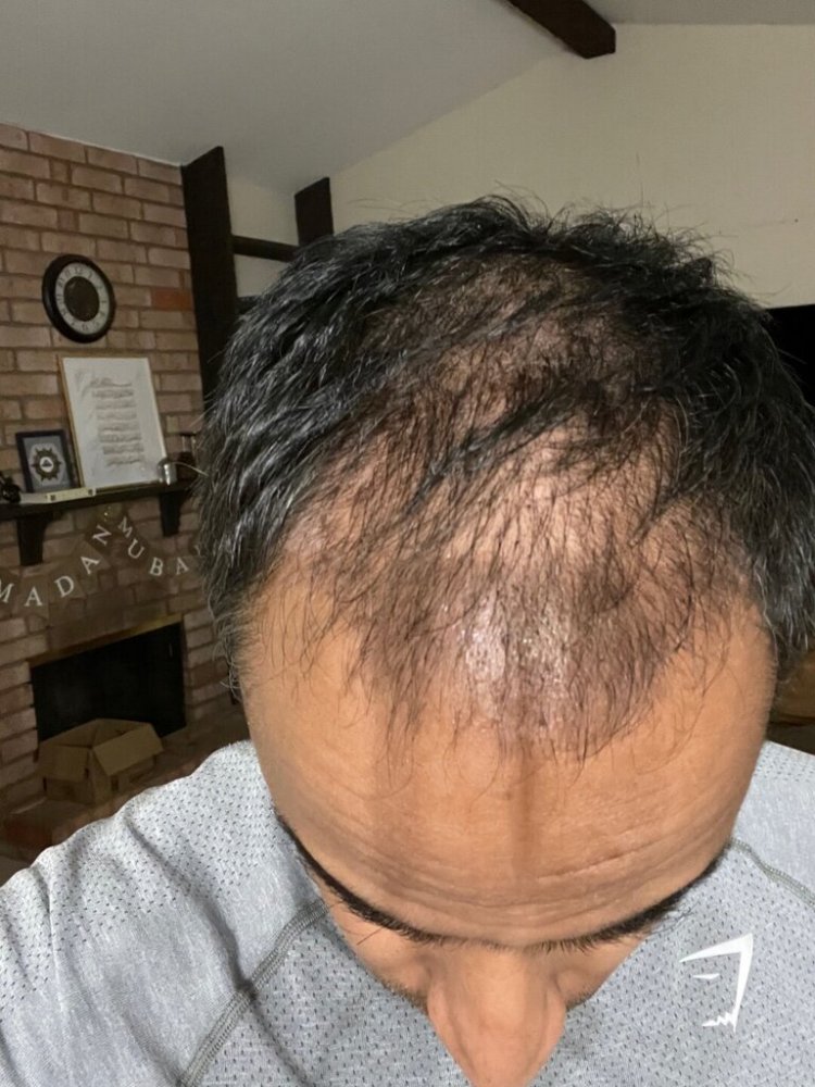 Dr. Ron Shapiro hair transplant5.jpeg