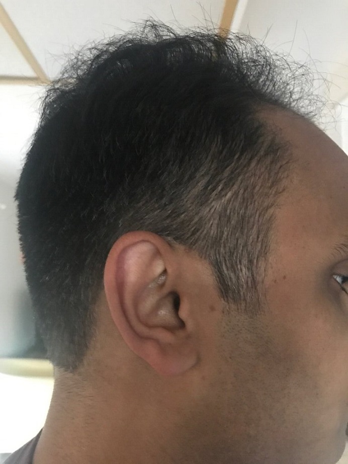 Dr. Ron Shapiro Hair Transplant7.jpeg