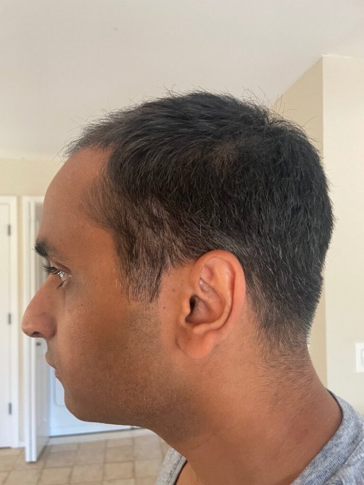 Dr. Ron Shapiro hair transplant7.jpeg
