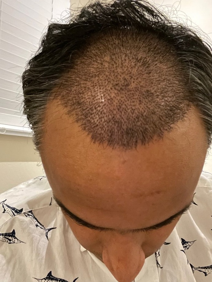 Dr. Ron Shapiro Hair Transplant8.jpeg