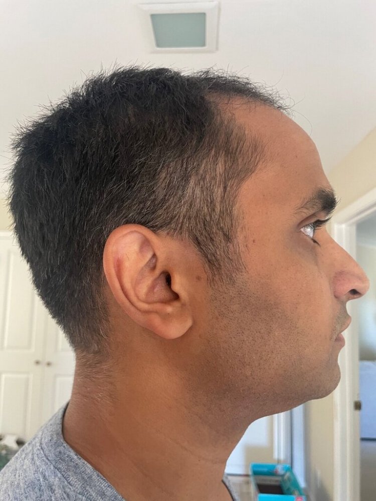 Dr. Ron Shapiro hair transplant8.jpeg