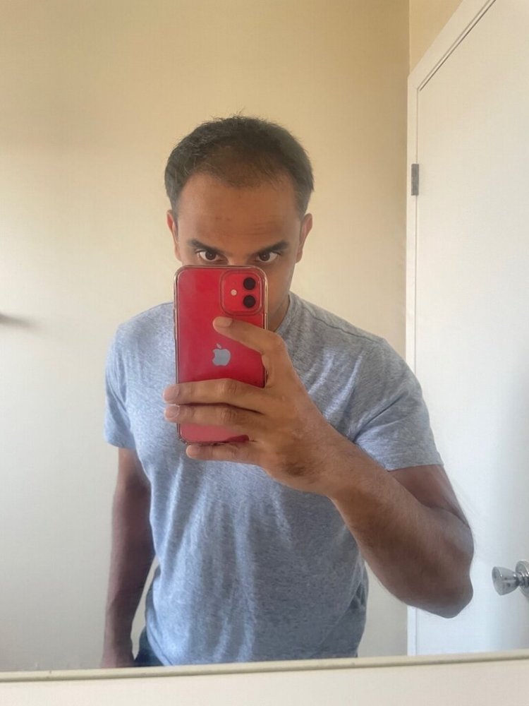 Dr. Ron Shapiro hair transplant9.jpeg