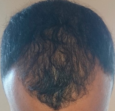 Dr Tayfun FUE  hair transplant.jpg