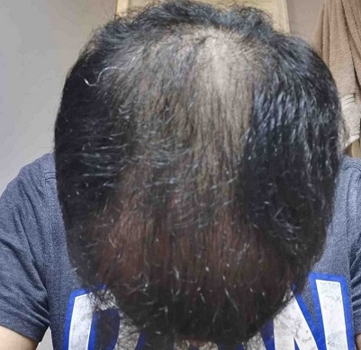 Dr Tayfun Hair transplant.jpg