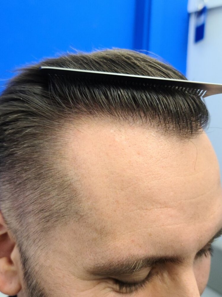 Dr. Wong, Hasson & Wong FUE Hair Transplant1.jpg