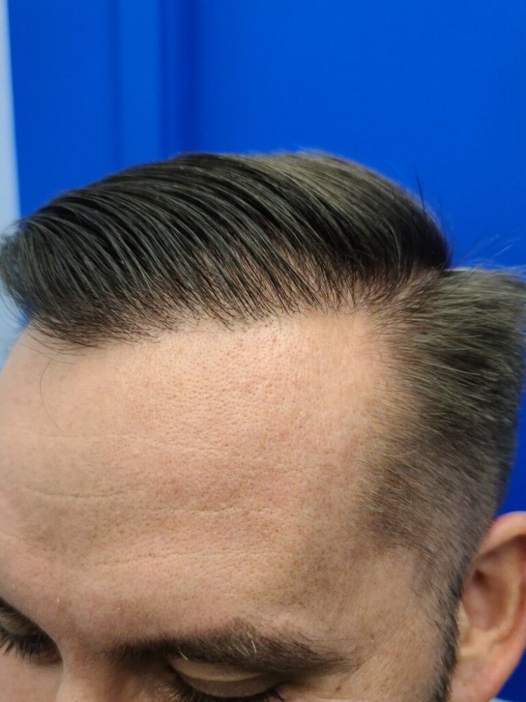 Dr. Wong, Hasson & Wong FUE Hair Transplant2.jpg