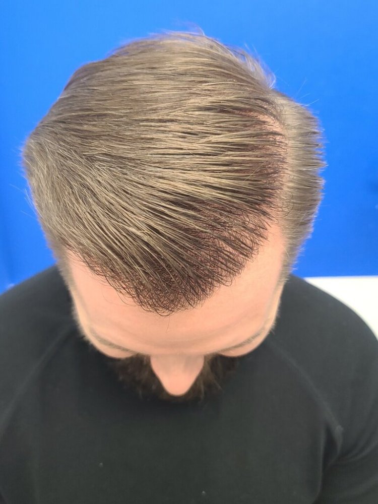 Dr. Wong, Hasson & Wong FUE Hair Transplant3.jpg