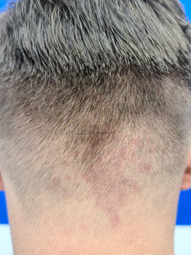 Dr. Wong, Hasson & Wong FUE Hair Transplant4.jpg