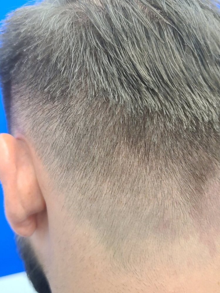 Dr. Wong, Hasson & Wong FUE Hair Transplant5.jpg