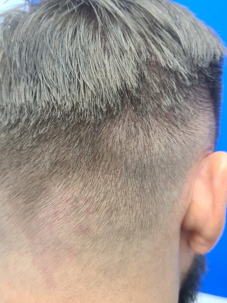 Dr. Wong, Hasson & Wong FUE Hair Transplant6.jpg