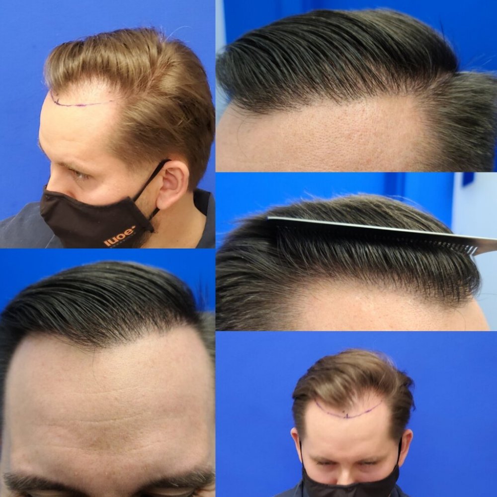 Dr. Wong, Hasson & Wong FUE Hair Transplant7.jpg