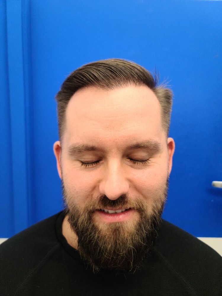 Dr. Wong, Hasson & Wong FUE Hair Transplant8.jpg