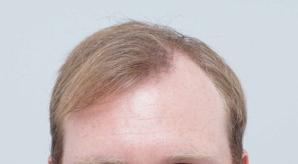 Farjo hair institute hair transplant1.jpg