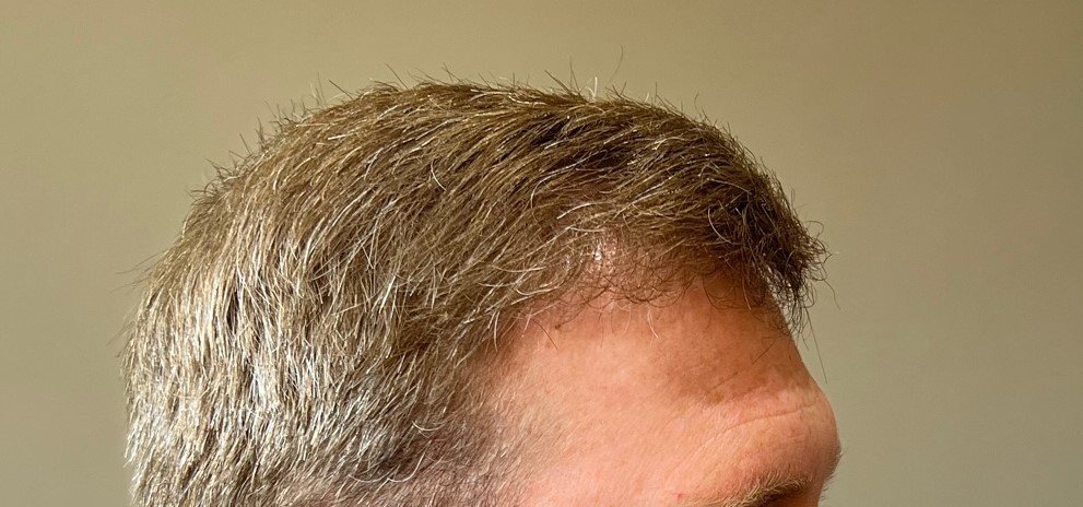 Farjo hair institute hair transplant10.jpg