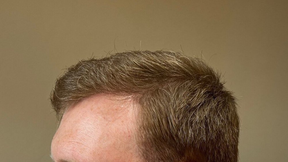 Farjo hair institute hair transplant11.jpg