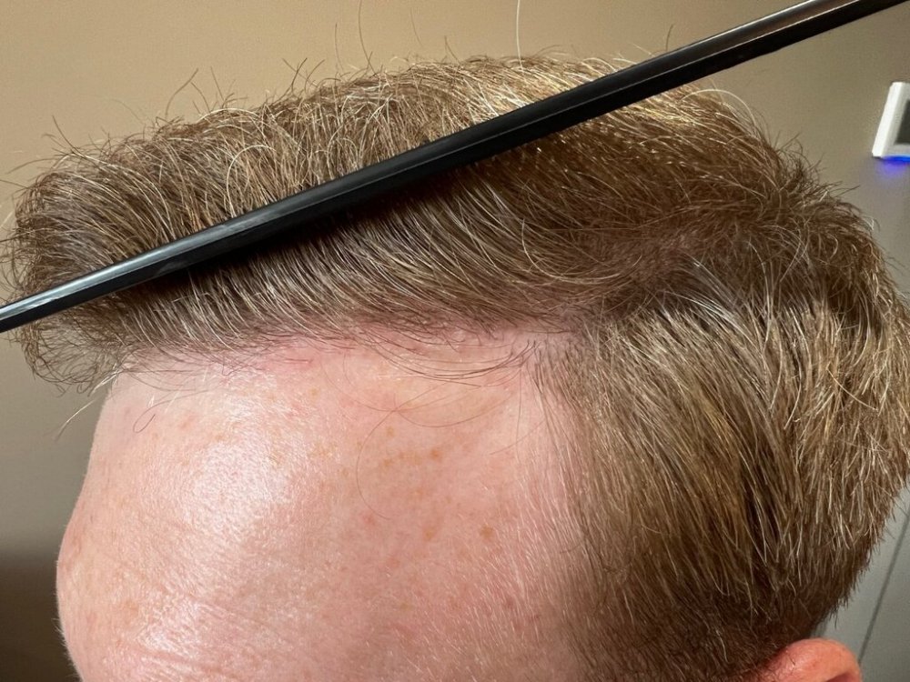 Farjo hair institute hair transplant12.jpg