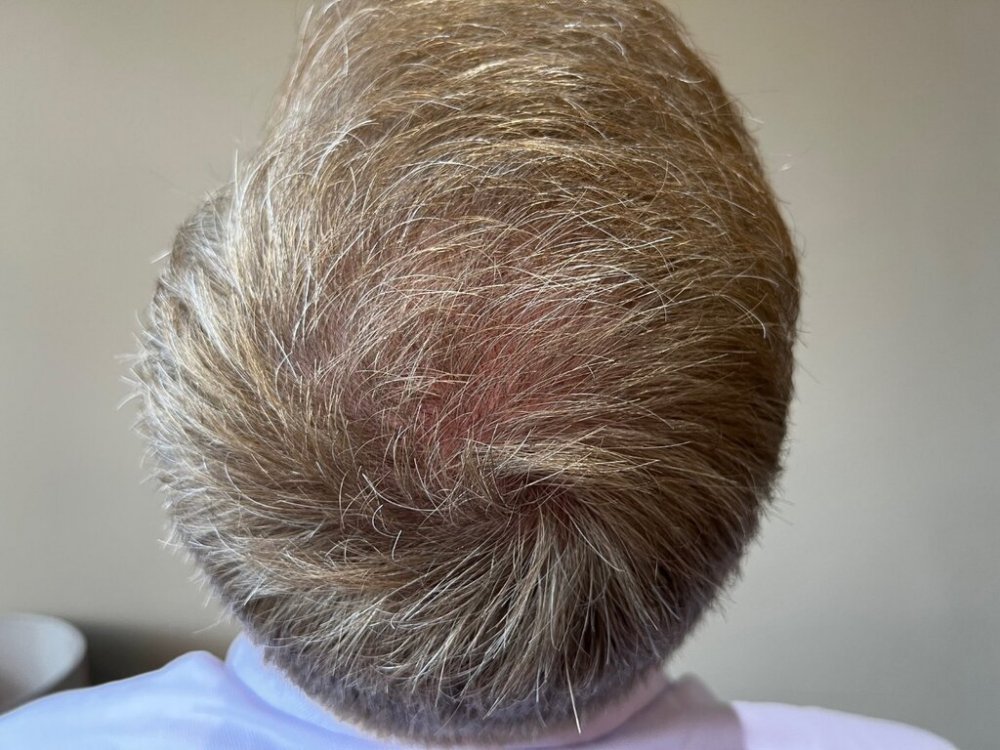 Farjo hair institute hair transplant13.jpg