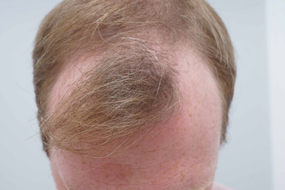 Farjo hair institute hair transplant2.jpg