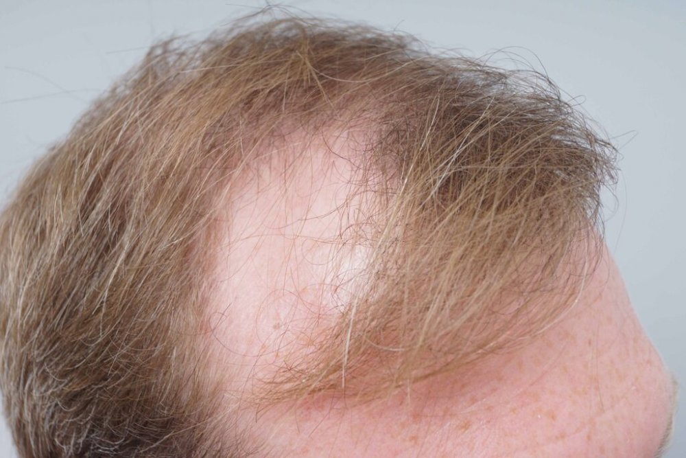 Farjo hair institute hair transplant3.jpg