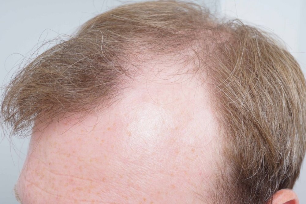 Farjo hair institute hair transplant4.jpg