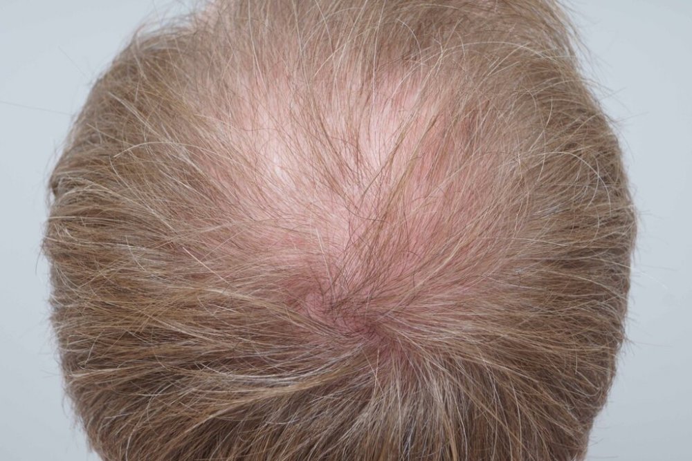 Farjo hair institute hair transplant5.jpg