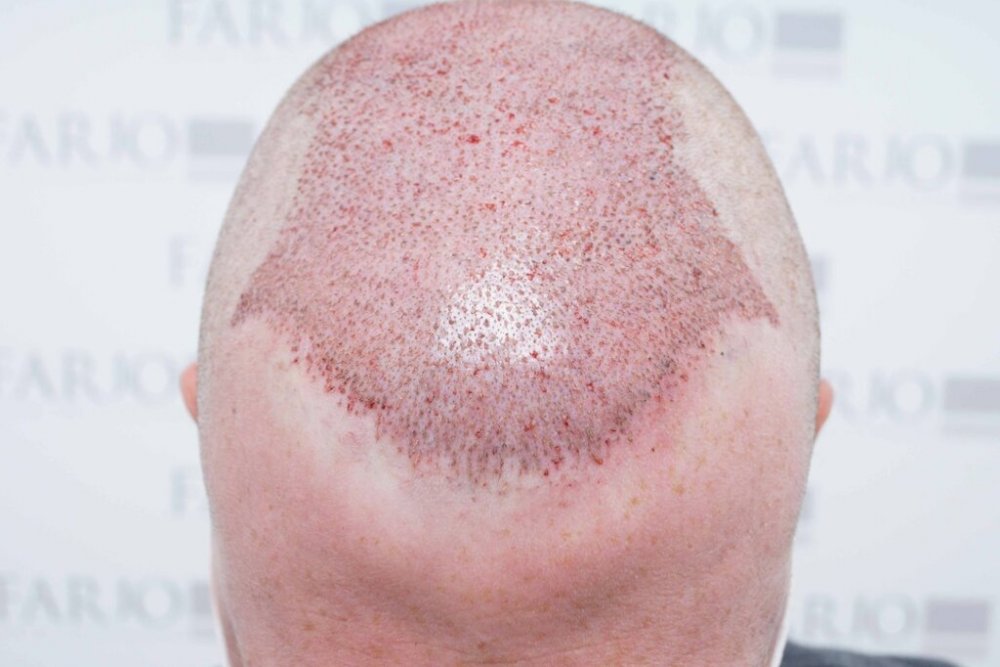 Farjo hair institute hair transplant6.jpg