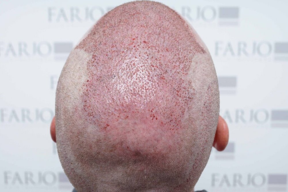 Farjo hair institute hair transplant7.jpg