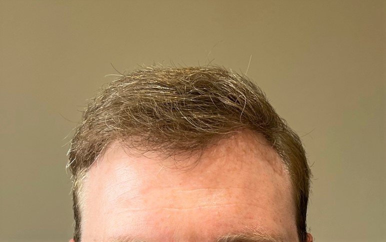 Farjo hair institute hair transplant8.jpg