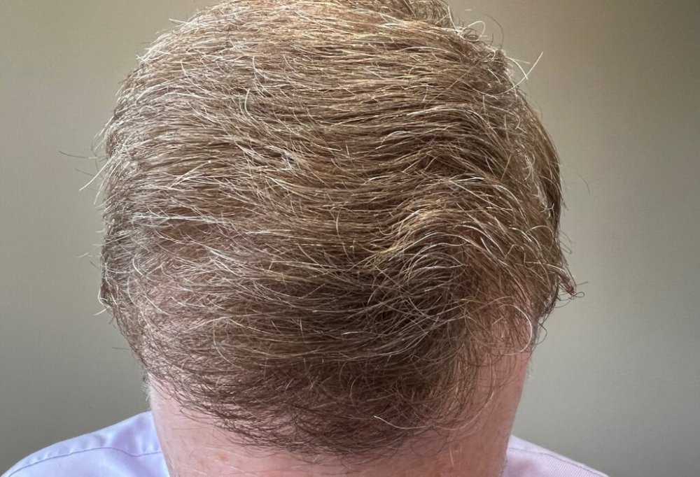Farjo hair institute hair transplant9.jpg