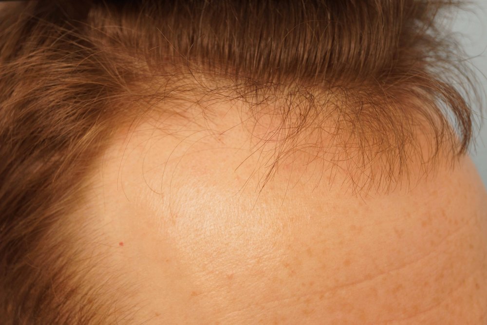 Farjo hair transplant 1.jpg