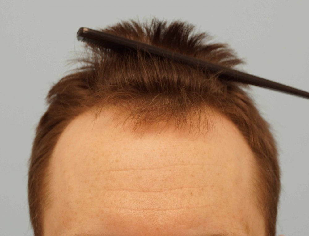 Farjo hair transplant 2.jpg