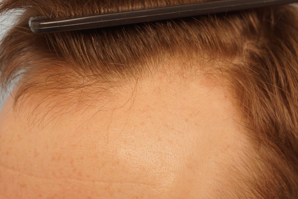 Farjo hair transplant 3.jpg