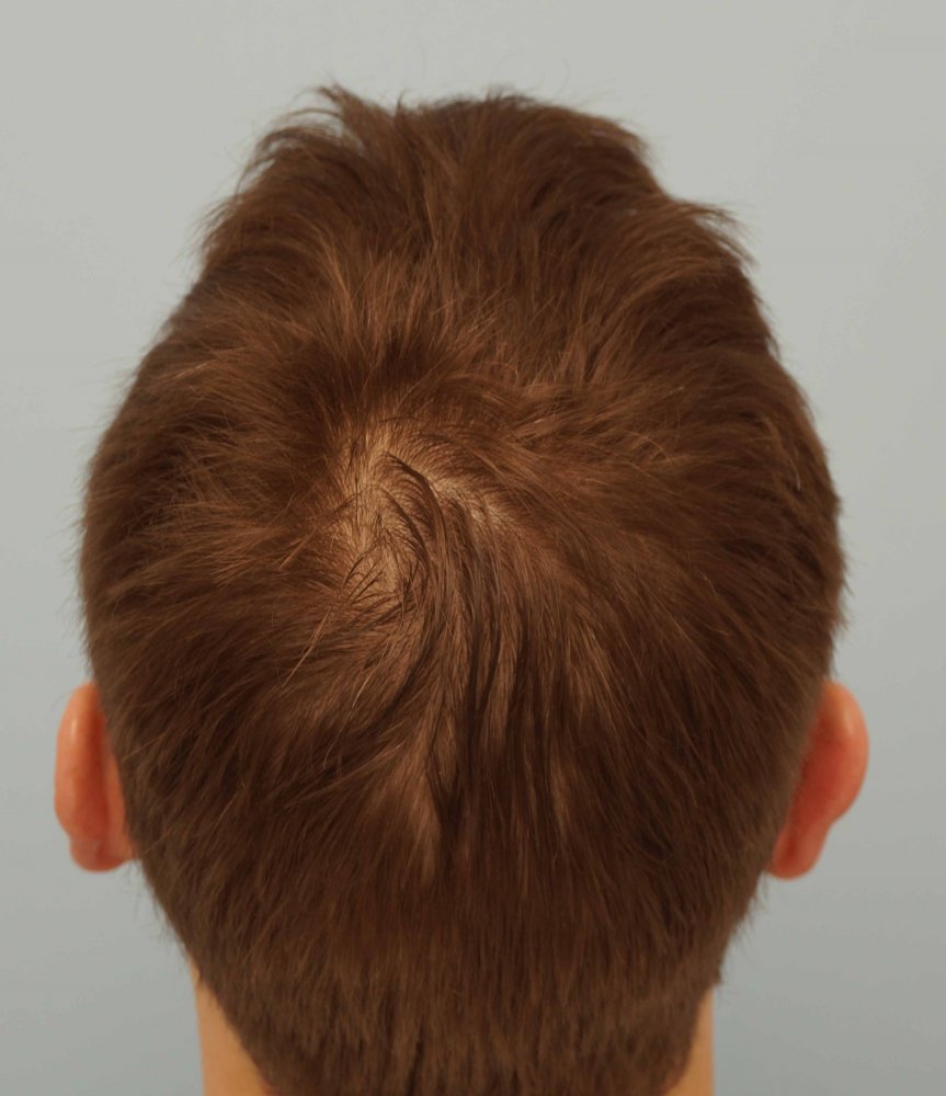 Farjo hair transplant 3a.jpg