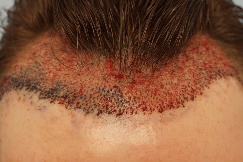 Farjo hair transplant 4.jpg