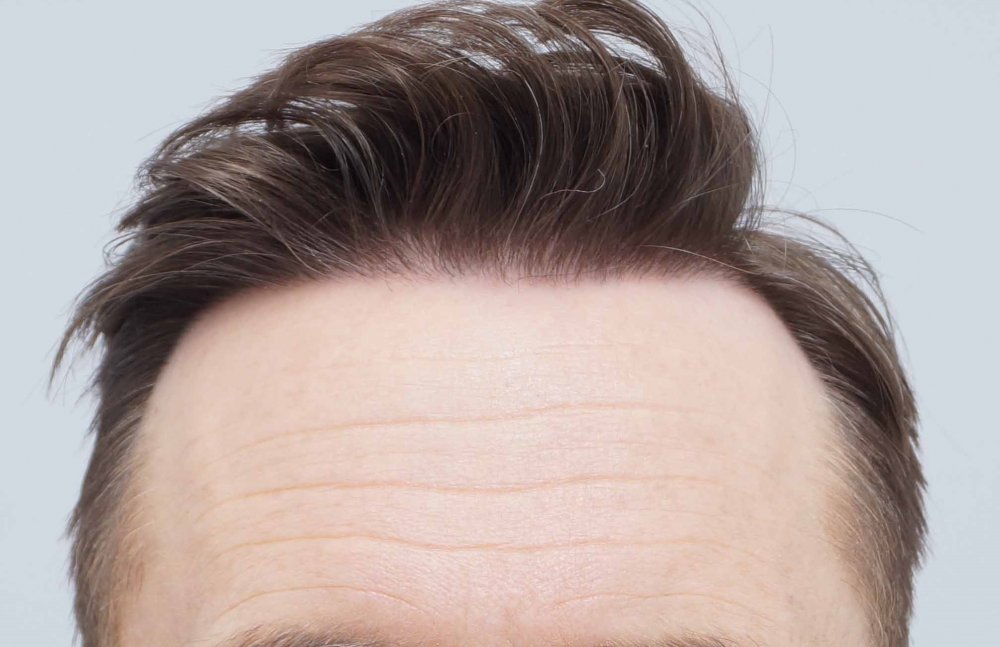 Farjo hair transplant 5.jpg