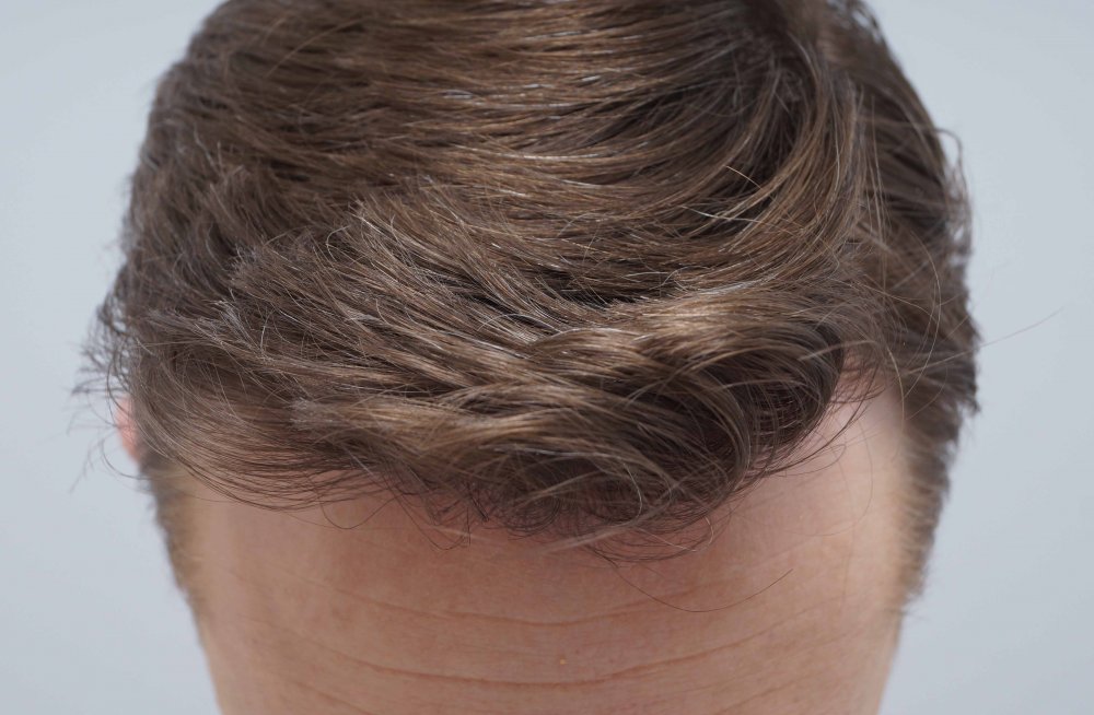 Farjo hair transplant 6.jpg