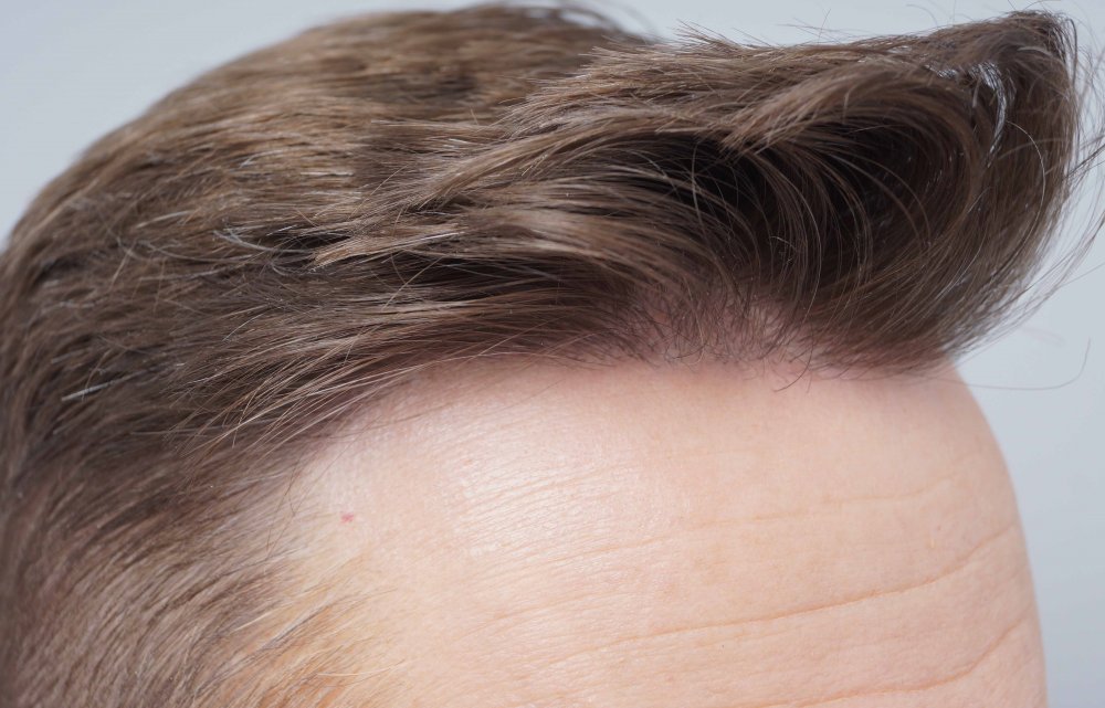 Farjo hair transplant 7.jpg