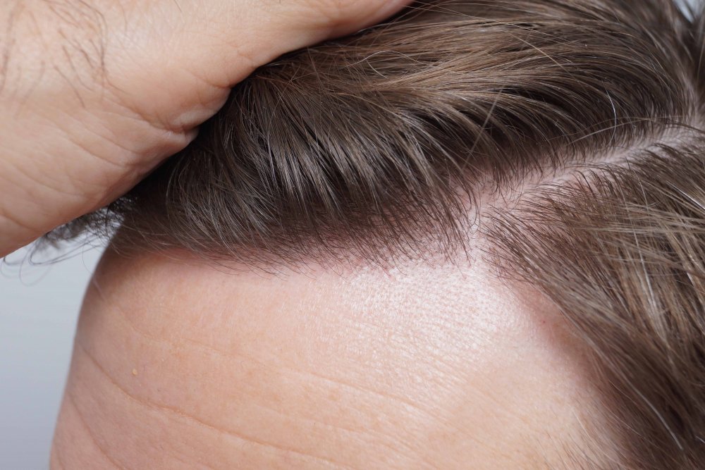 Farjo hair transplant 8.jpg