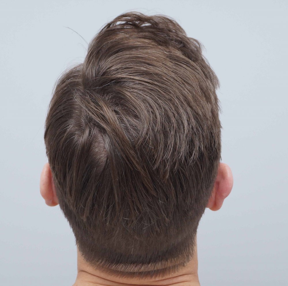 Farjo hair transplant 9.jpg