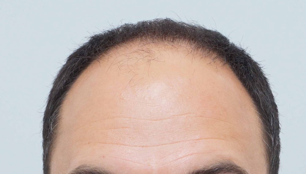Farjo hair transplant1.jpg