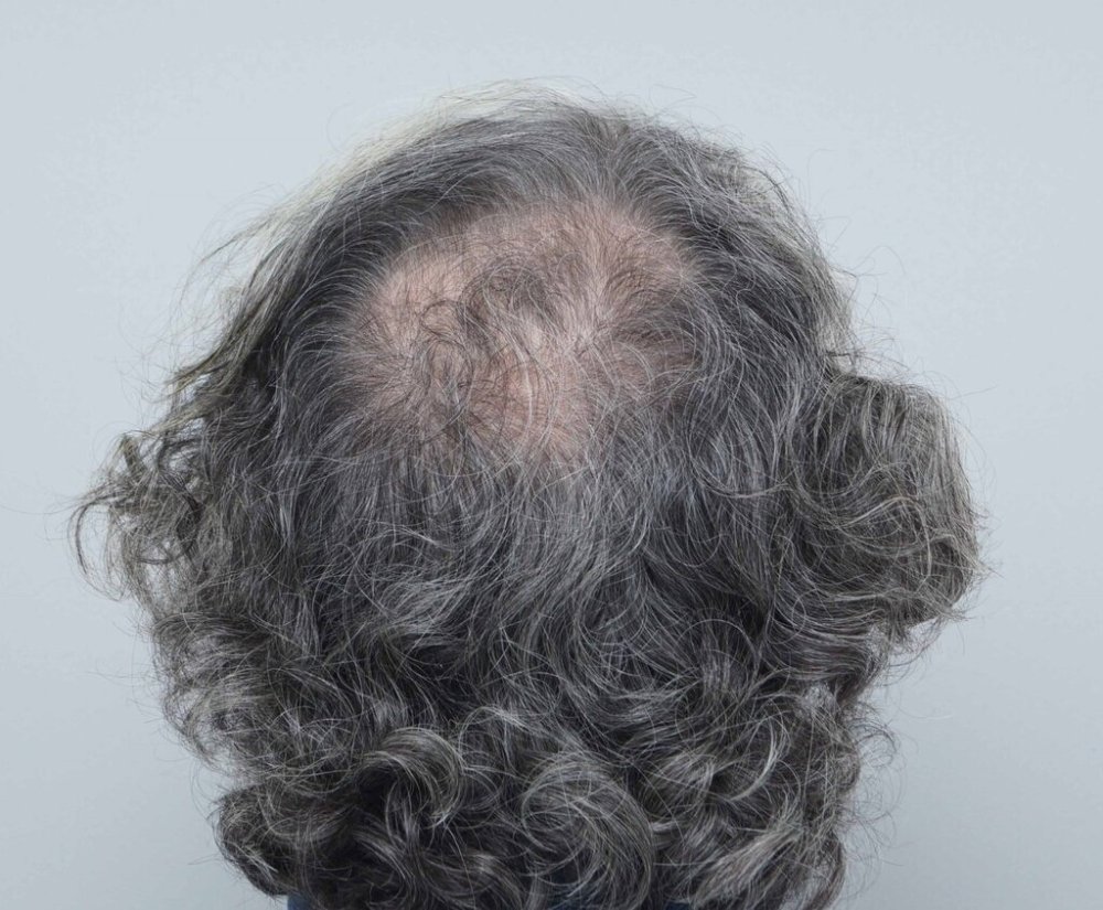 Farjo hair transplant1.jpg