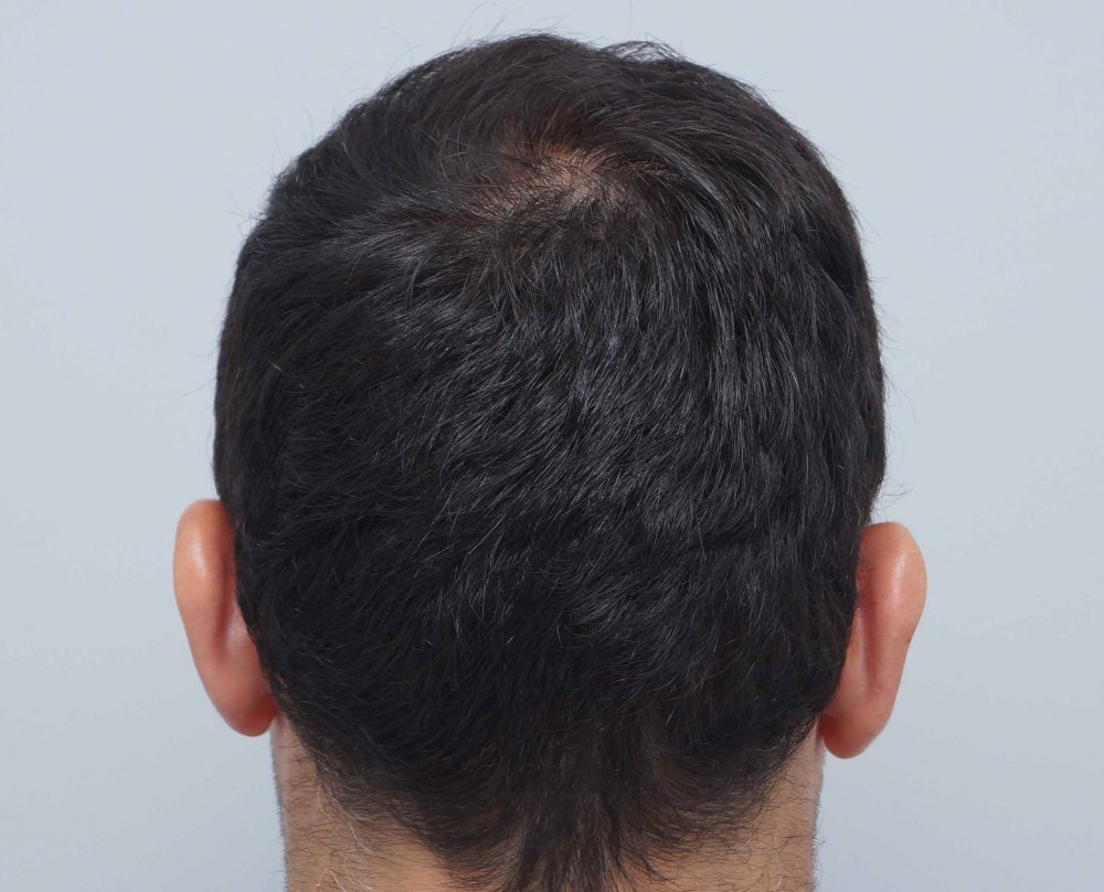 Farjo hair transplant10.jpg
