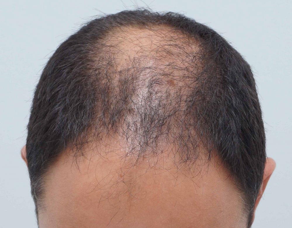 Farjo hair transplant2.jpg