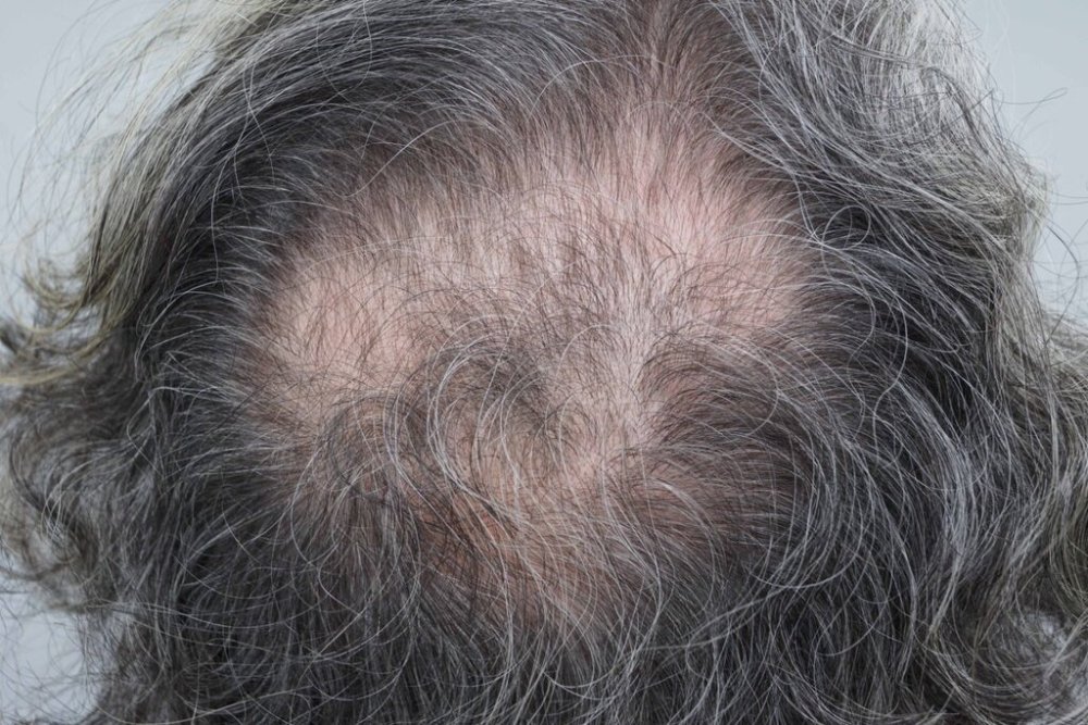 Farjo hair transplant2.jpg