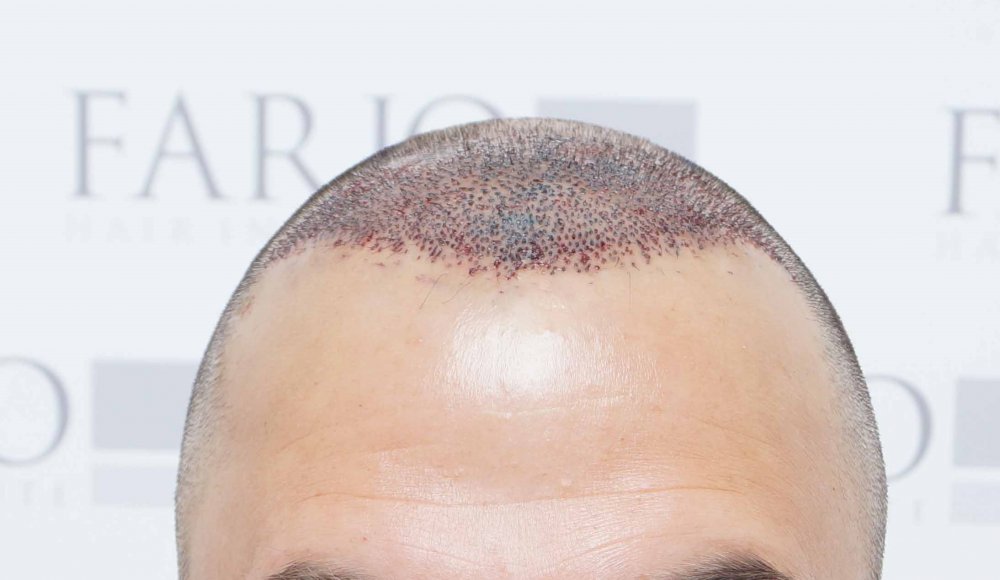 Farjo hair transplant3.jpg
